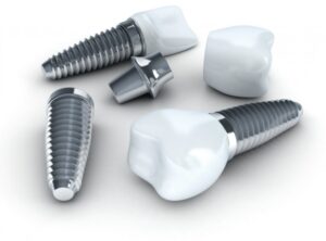 Dental Implant Plano TX