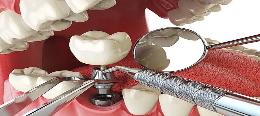 Dental Implant Procedure Painful
