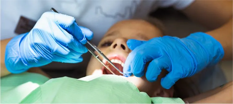 Do Dental Plans Cover Wisdom Teeth Extractions?