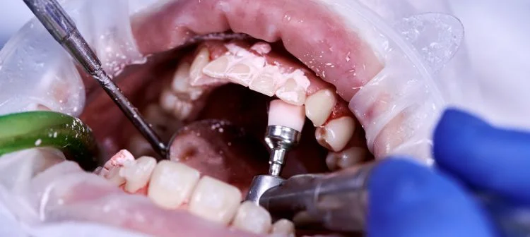 prepare for dental implant surgery