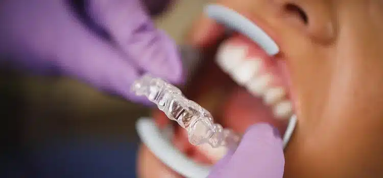 How Long Do You Have To Wear Invisalign?