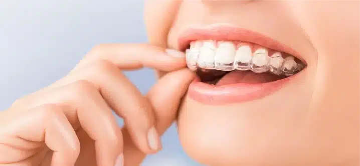  Maintain Dental Health While Using Invisalign 