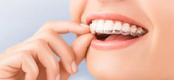 Maintain Dental Health While Using Invisalign